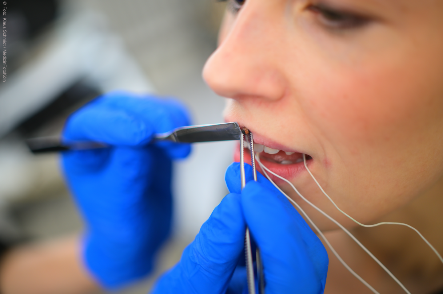 Carstens AG501 Articulograph sensor applied to participants upper lip.